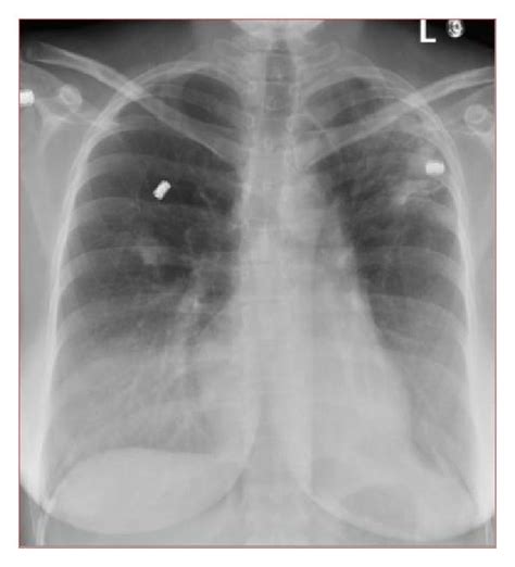 suspicious densities in both upper lobes|Chest xray result.